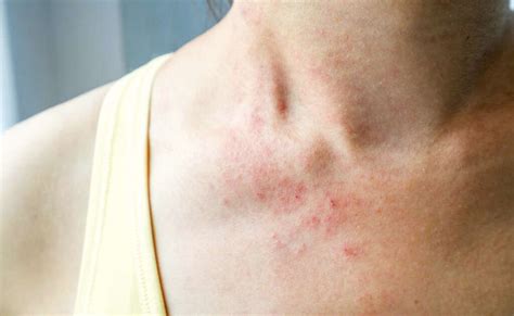 Mononucleosis 10 Mononucleosis Symptoms