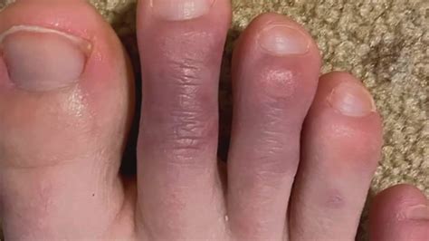 Itchy And Swollen Toes Could Be Signs Of Covid 19 Science