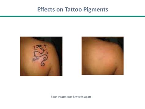 Everything About Tattoo Removal Mega Network