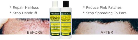 Nemtrex Medicated Shampoo 8 Oz