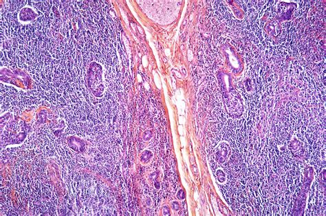 Salivary Gland Cancer Light Micrograph Stock Image M1321012