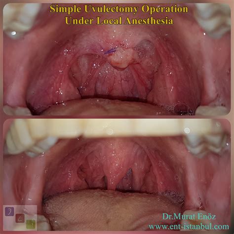 Uvula Alongada O Que Fazer