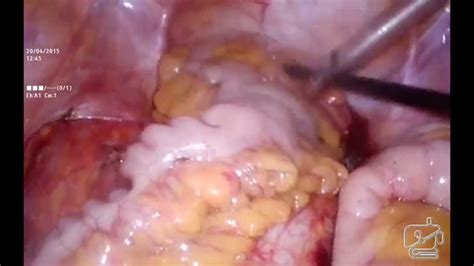 Laparoscopic Very Low Anterior Resection With Handsewn Coloanal My