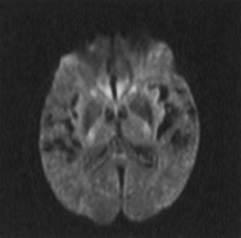 Early Detection Of Global Cerebral Anoxia Improved Accuracy By High B