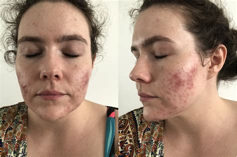 Adult Acne Is The Worst And More Australians Than Ever Are Dealing With It Platinum Dermatology