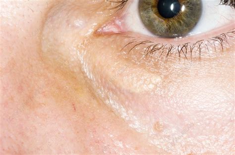 Xanthelasma Growth Stock Image C0016625 Science Photo Library