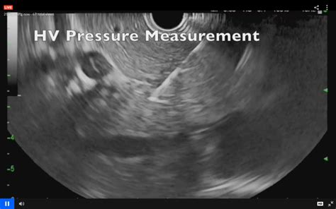 Novel Technique Allowing Direct Measurement Of Portal Pressure
