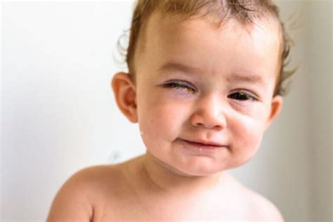 Pink Eye In Babies And Kids Early Signs And Pediatricians Tips