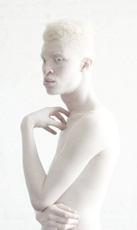 99 Albinos Ideas Albinism Albino Albino Model