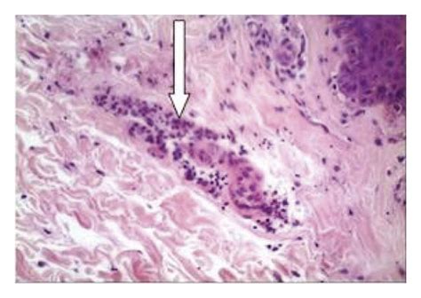 Adult Onset Still Disease A Skin Biopsy With A Multiple Individual