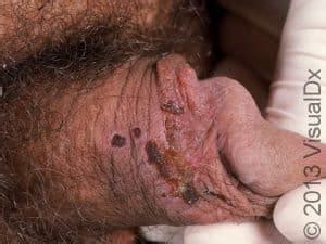 Genital Herpes HSV Symptoms Treatment Prevention