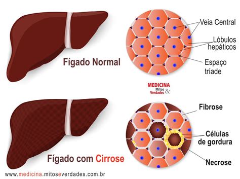 O Fígado é Um órgão Parenquimatoso Repleto De Sangue
