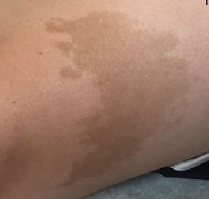Die differentialdiagnose zu anderen pigmentierten hautveränderungen sollte durch den spezialisten erfolgen. Café Au Lait Spots | Consultant360