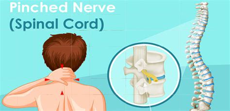 Pinched Nerve Pain San Ramon