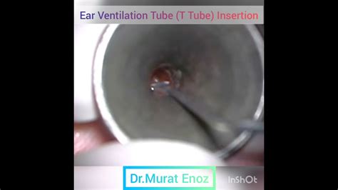 Ear Ventilation Tube T Tube Placement Youtube