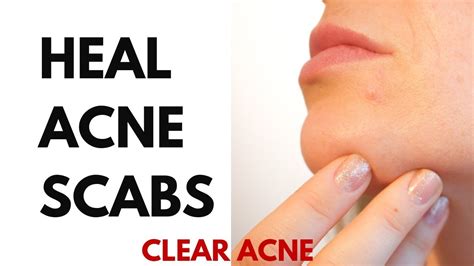 How To Heal Acne Scabs Youtube