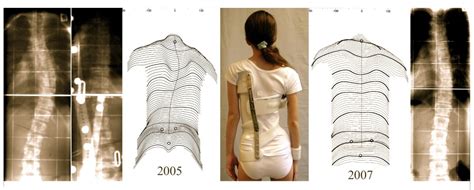 Brace Technology Thematic Series The Scoliologic Chêneau Light