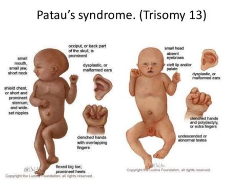 Hội chứng Patau là gì