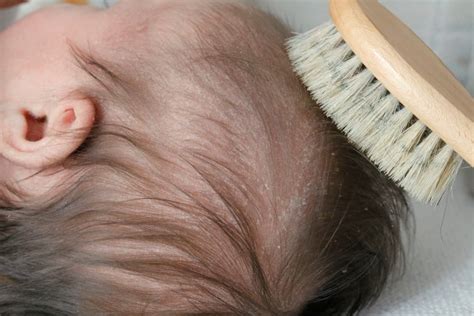 Six Natural Treatments For Cradle Cap In Babies And Toddlers