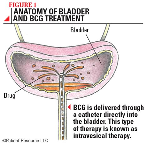 Bladder Cancer Sitc Connected