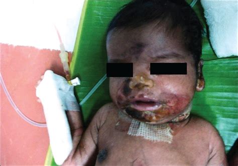 Staphylococcal Scalded Skin Syndrome Ssss Concise