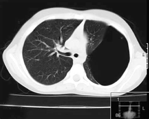 A Large Thin Walled Cyst In Thorax Ct Of The Patient Download
