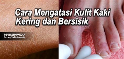 Mohon Bantu Share Ya!! Cara Mengatasi Kulit Kaki Kering ...