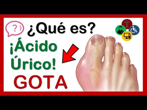 Qué es LA GOTA Causas síntomas y TRATAMIENTO YouTube