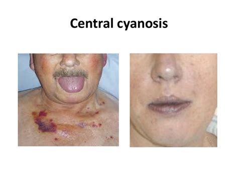 Cyanosis Ppt By Dr Girish Jain