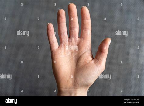 Causing Dermatitis Hi Res Stock Photography And Images Alamy