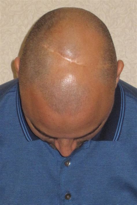 Balding Treatments That Work Well Hair Loss Talk