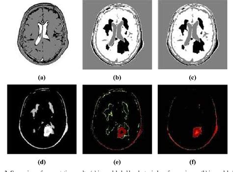 Brain Tumor Detection Using Color Based K Means Clustering Segmentation