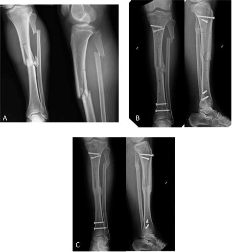 A Injury Radiographs Of A Tibia Fracture B Postoperative Image Of