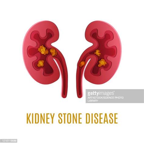 Kidney Stone Illustration Photos And Premium High Res Pictures Getty