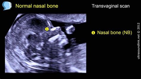 Vlog feel free to mail us stuff our p.o box address to the name. This is a training ultrasound video about assessment of the fetal nasal bone… (mit Bildern)