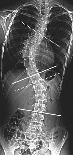 Scoliosis Imaging What Radiologists Should Know Radiographics