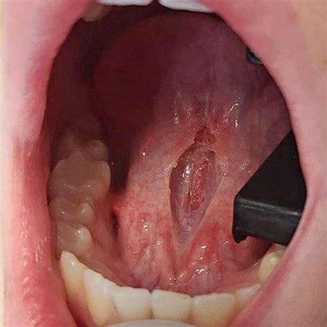 Tongue Tie Fascia Release With Lightscalpel Laser Update