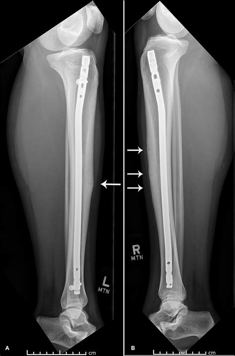Frontiers Concurrent Bilateral Anterior Tibial Stress Fractures And