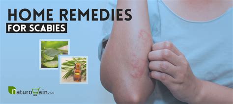 7 Best Home Remedies For Scabies To Prevent Skin Rashes