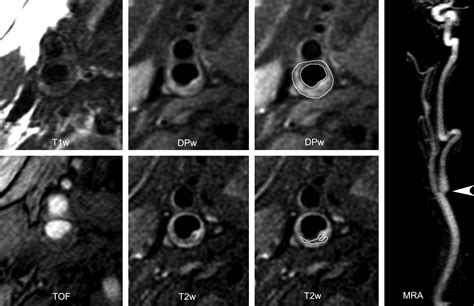 Reproducibility Of High Resolution Mri For The Identification And The