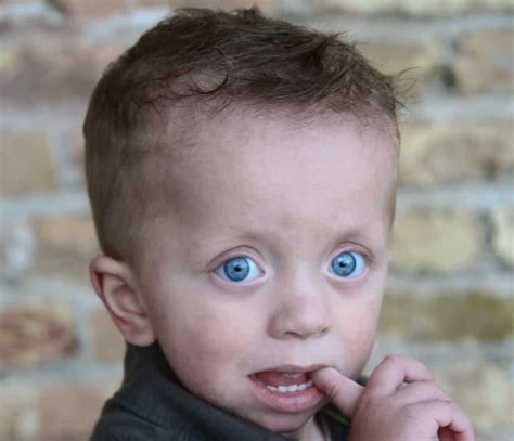 Noonan Syndrome What Is Noonan Syndrome