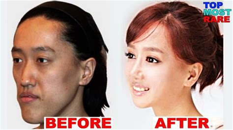 Japanese Celebrity Plastic Surgery Before And After