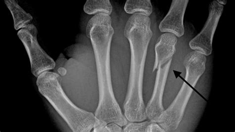 635666946889594310 Neck Fracture Of The Fourth Metacarpal Bonepng