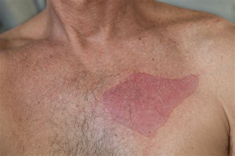 Do not use any cosmetic products at the sites. How to Treat a Burn From Nair (with Pictures) | eHow