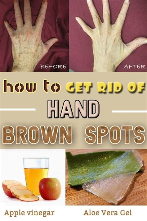 How to get rid of hand brown spots | Brown spots on hands ...