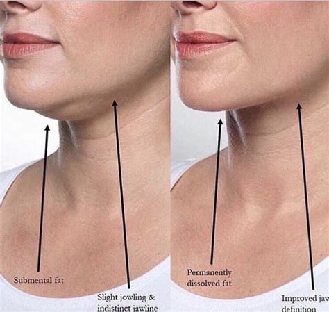 Laser Therapeutics Double Chin Treatment