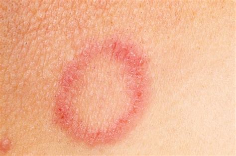 What Causes Ringworm In Humans Pictures Photos