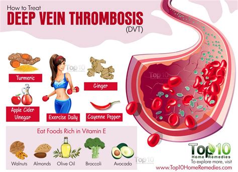 How To Deal With Deep Vein Thrombosis Dvt Top 10 Home Remedies