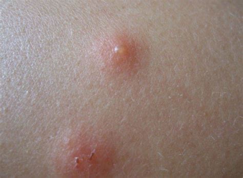 Astepaway New Search Experience Bed Bugs Bites Skin Bed Bug Bites