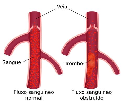 Trombosis Causas síntomas y tratamientos Enfermedades